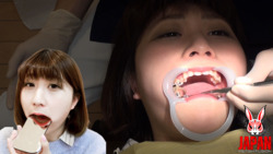 Dental Treatment ; Mikoto MISAKA, 21yrs old!  (3rd Time)